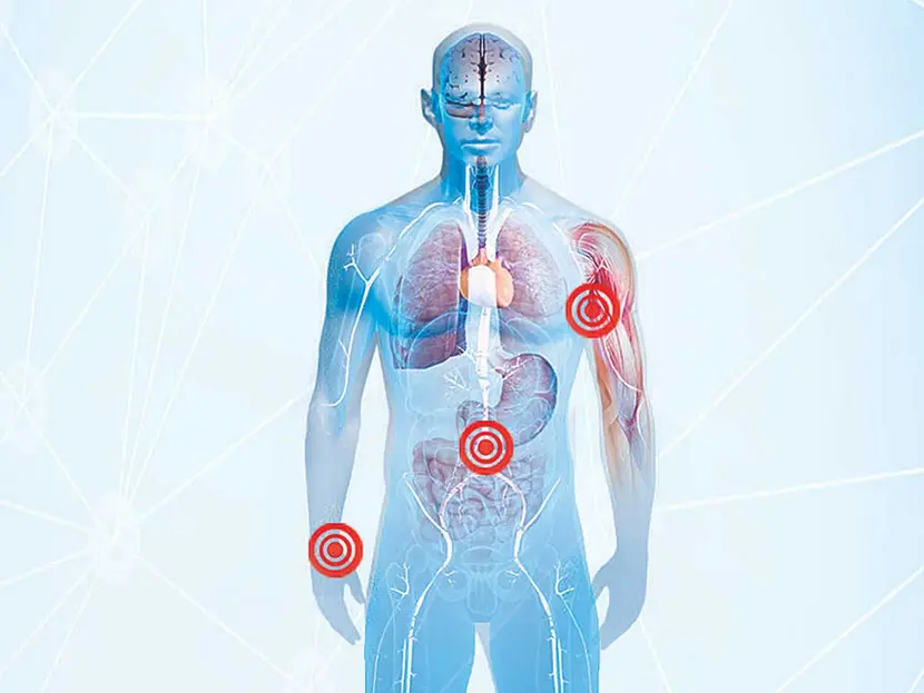 Guillain-Barré cobra su tercera víctima; van 21 casos confirmados en Tlaxcala