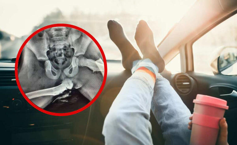 Mujer se fractura 5 partes del cuerpo por poner los pies en el tablero del carro