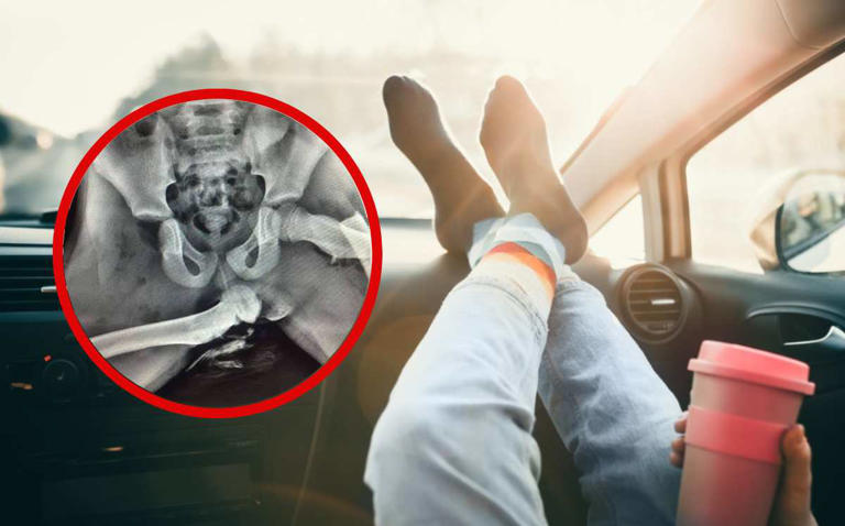 Mujer se fractura 5 partes del cuerpo por poner los pies en el tablero del carro